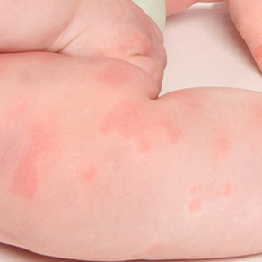Лечение аллергической крапивницы: симптомы и причины