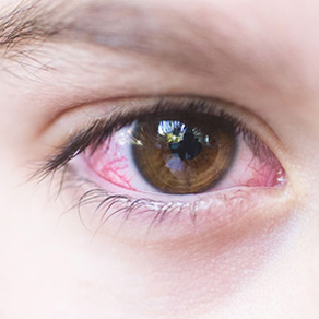 Конъюнктивит глаз - лечение у детей